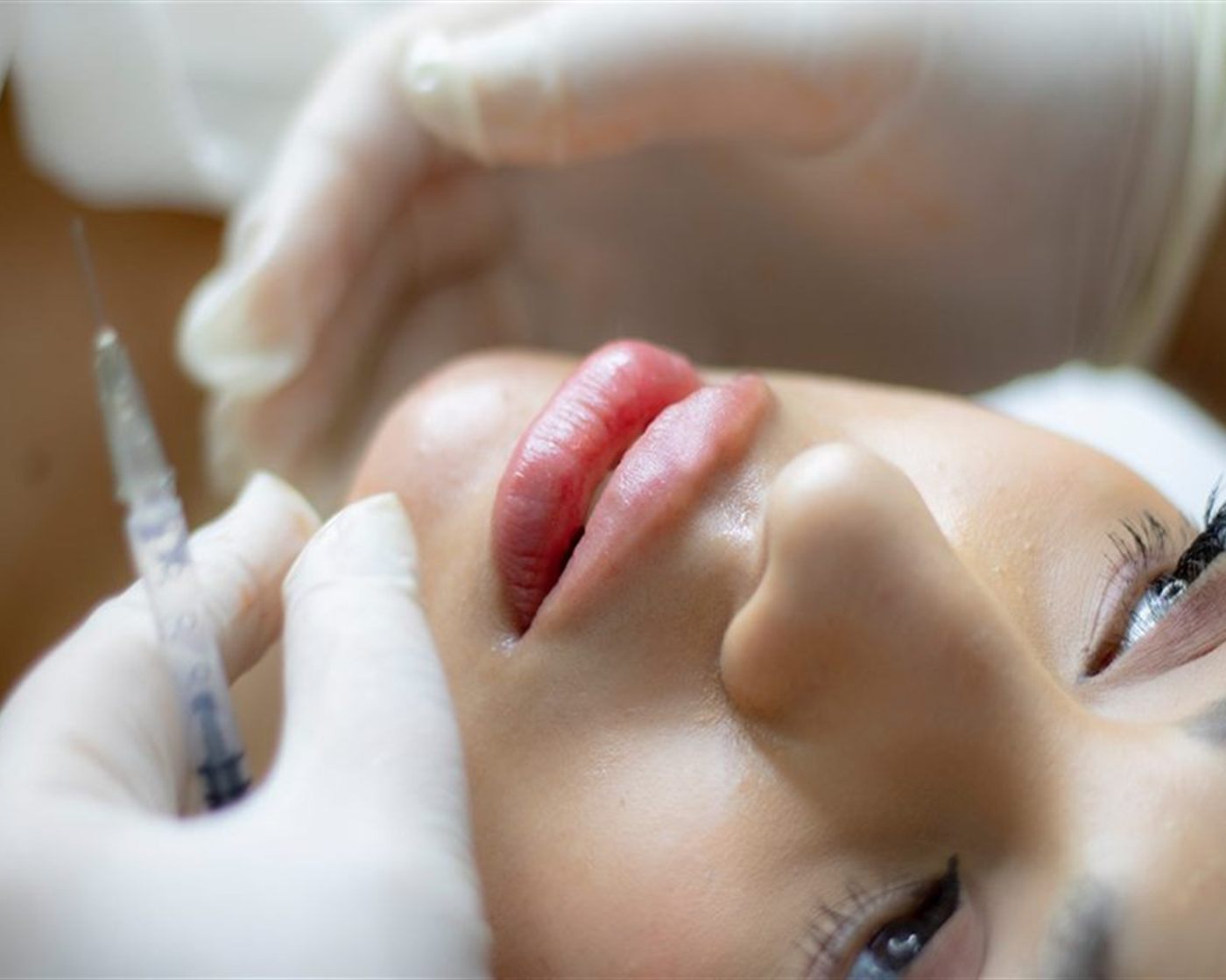 Hyaluronic acid lip filler being administered at Florida Healthcare Solutions in Cutler Bay